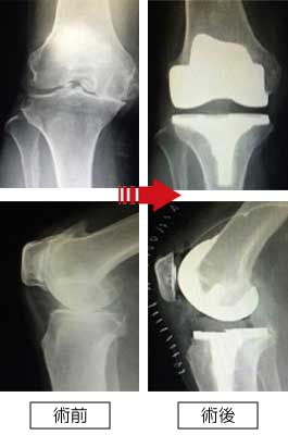 右変形性膝関節症