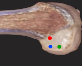 青・緑正しい骨孔位置　赤　高すぎる経脛骨骨孔