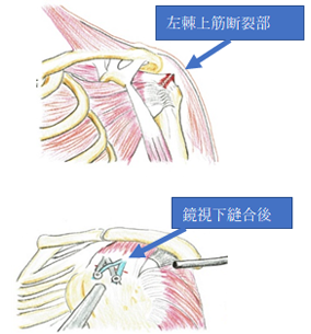 左肩後方より見た腱板の解剖